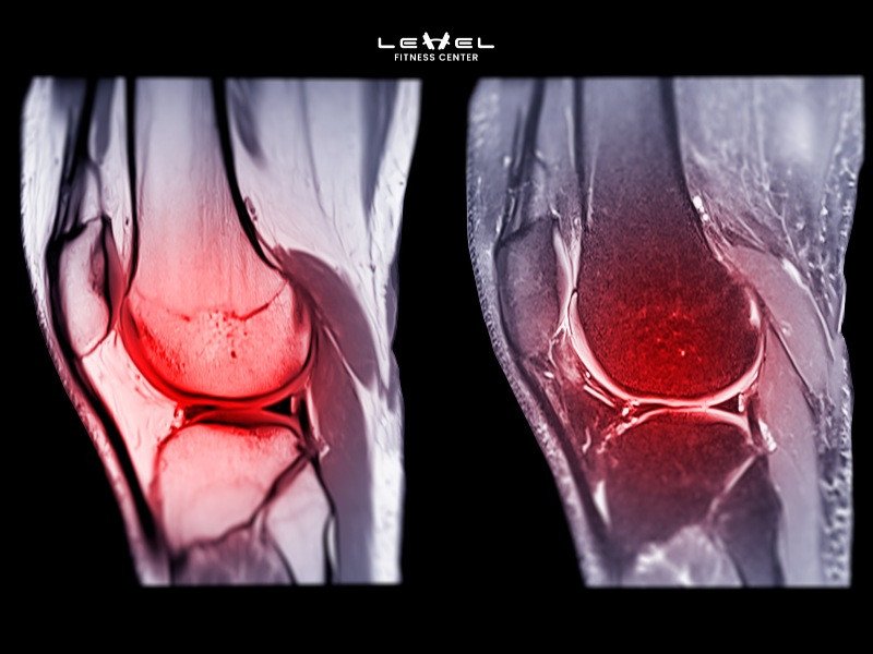 Hình ảnh minh họa một người bị căng cơ bắp chân, với biểu cảm đau đớn